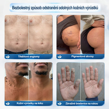 🥰Oficiální značkový obchod | Hiskin® 7denní odstraňovač skvrn a pigmentových skvrn (Bezbolestný rollerball bez jizev)🐬
