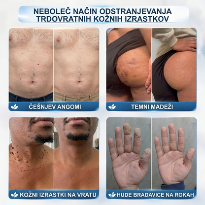 🥰Uradna trgovina|✅️👩‍⚕️𝐇𝐈𝐒𝐊𝐈𝐍®7 dnevni odstranjevalec kožnih izrastkov in madežev(𝐫𝐨𝐥𝐥-𝐨𝐧 𝐚𝐩𝐥𝐢𝐤𝐚𝐭𝐨𝐫: 𝐛𝐫𝐞𝐳 𝐛𝐨𝐥𝐞č𝐢𝐧 𝐢𝐧 𝐛𝐫𝐚𝐳𝐠𝐨𝐭𝐢𝐧)🌳