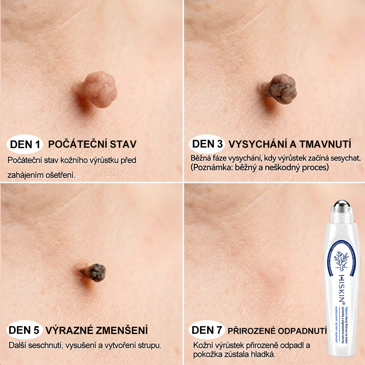 🥰Oficiální značkový obchod | Hiskin® 7denní odstraňovač skvrn a pigmentových skvrn (Bezbolestný rollerball bez jizev)🐬