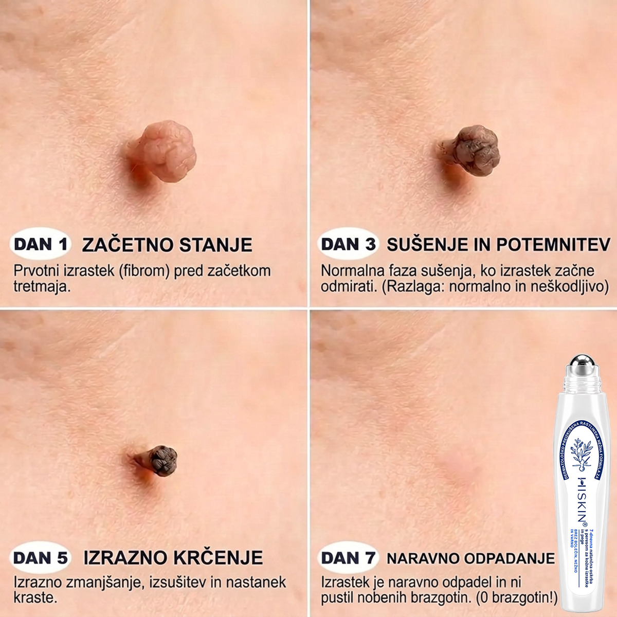 🥰Uradna trgovina|✅️👩‍⚕️𝐇𝐈𝐒𝐊𝐈𝐍®7 dnevni odstranjevalec kožnih izrastkov in madežev(𝐫𝐨𝐥𝐥-𝐨𝐧 𝐚𝐩𝐥𝐢𝐤𝐚𝐭𝐨𝐫: 𝐛𝐫𝐞𝐳 𝐛𝐨𝐥𝐞č𝐢𝐧 𝐢𝐧 𝐛𝐫𝐚𝐳𝐠𝐨𝐭𝐢𝐧)🌳